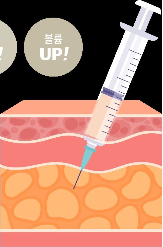 피부 단면과 주사기를 통한 지방이식 주입 과정 일러스트