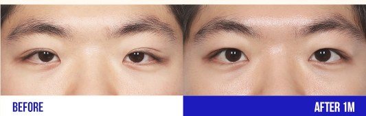 눈 성형 전후 비교 사진 5