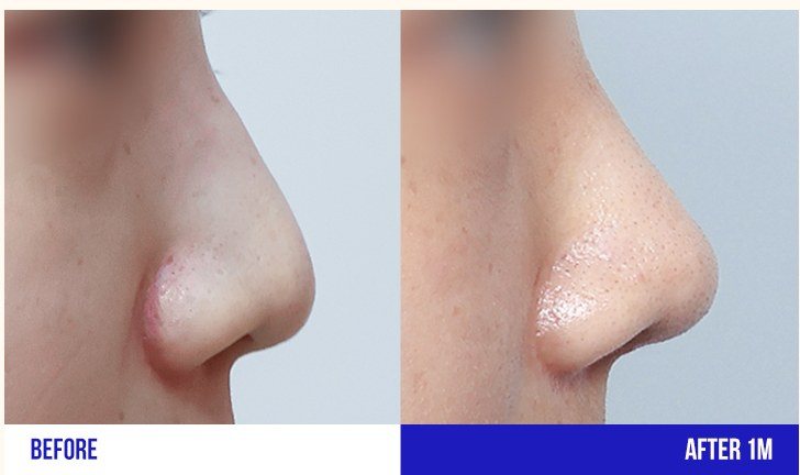 무보형물 코성형 전후 비교 사진 1