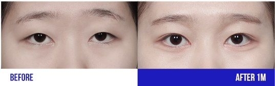 눈 성형 전후 비교 사진