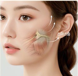 얼굴 근육과 스마스층 리프팅 방향을 보여주는 일러스트