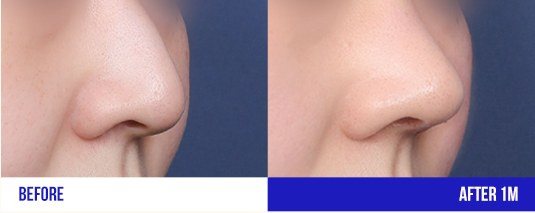 코 성형 전후 비교 사진 (상단 일부)