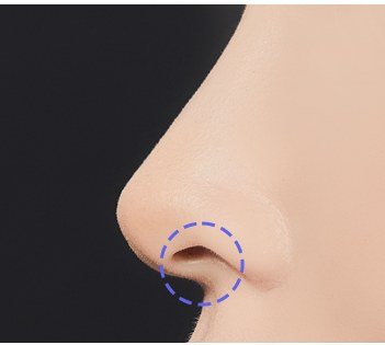 수술 시작 절개 부위 일러스트