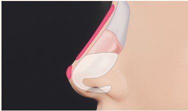 보형물 삽입 과정 일러스트