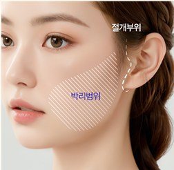 절개부위와 박리범위가 표시된 여성 측면 얼굴 일러스트
