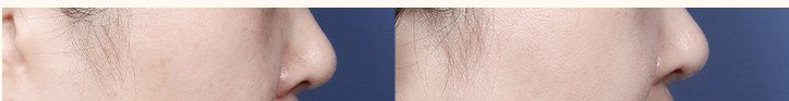 이중턱 및 턱선 시술 전후 비교 사진 일부