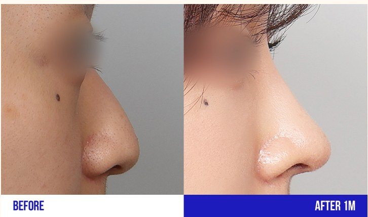 코 성형 측면 전후 사진