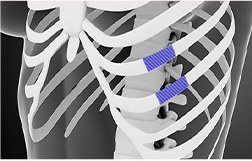 가슴연골 채취 부위 3D 일러스트