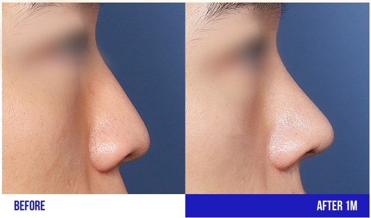 코 성형 전후 측면 비교 사진 5
