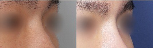 남자 코 성형 전후 비교 사진 (하단 일부)