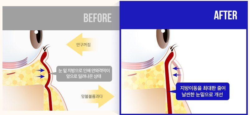 눈 밑 지방 재배치 및 격막 고정 원리를 설명하는 BEFORE/AFTER 단면 일러스트