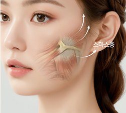 SMAS층 리프팅 그래픽 모델 사진