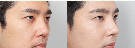 남성 얼굴 전후 비교 사진 (하단 일부)