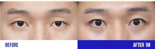 눈 성형 전후 비교 사진 4