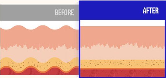 피부 단면 BEFORE and AFTER 비교 일러스트