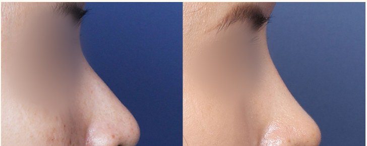 코 성형 전후 사진 (측면)