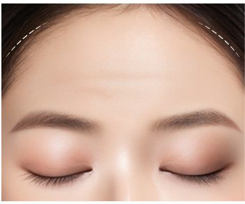 수술 전 이마 일러스트