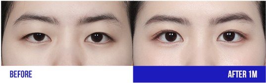 눈 성형 전후 비교 사진