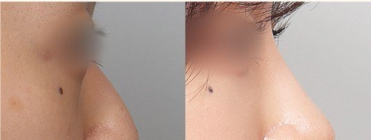코 성형 전후 확대 사진