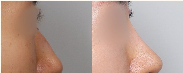 코 성형 전후 사진 (측면)
