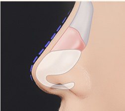 절개 및 삽입 공간 확보 일러스트