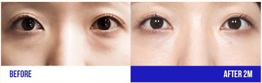 눈 성형 전후 사진 (여성, 2개월 경과)