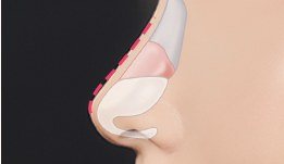 코 수술 공간 확보 일러스트