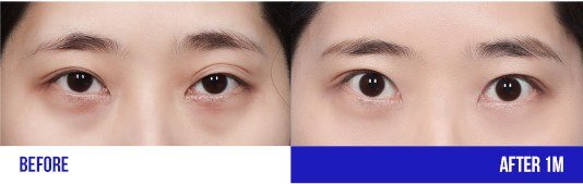 눈 성형 전후 비교 사진 (BEFORE / AFTER 1M)