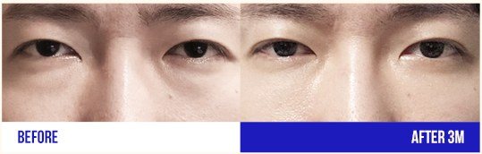 눈 성형 전후 사진 (남성, 3개월 경과)