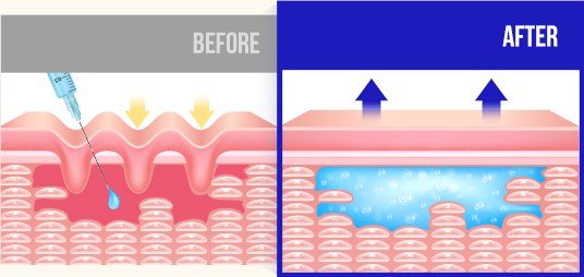 필러 시술 전후 피부 단면 변화를 나타낸 BEFORE/AFTER 일러스트
