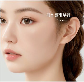 헤어라인 최소 절개 부위가 표시된 여성 모델