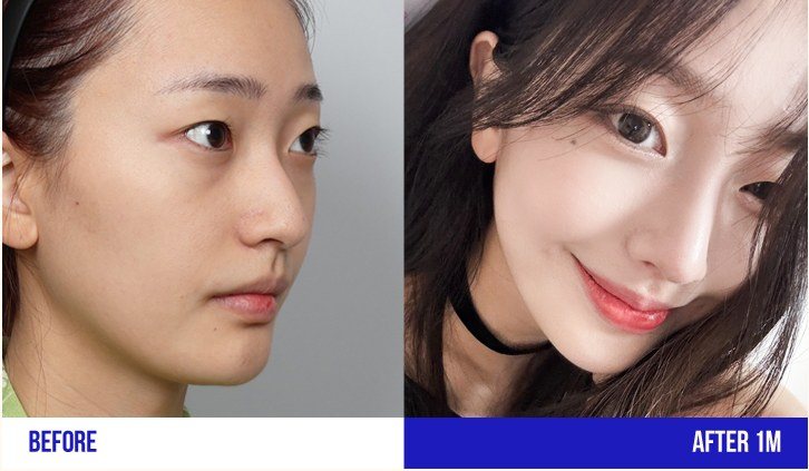 여성 코 성형 전후 사진