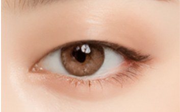 수술 전 눈 상태