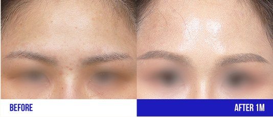 이마 부위 시술 전후 비교 사진 (BEFORE / AFTER 1M)