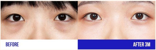 눈 성형 전후 사진 (여성, 3개월 경과)