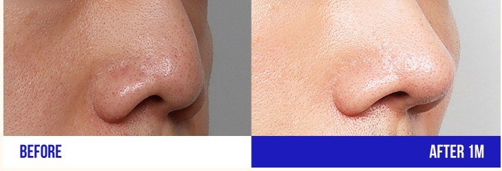 코 성형 전후 비교 사진 2