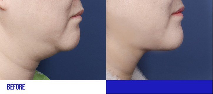 턱선 전후 비교 사진