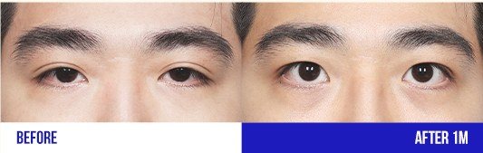 눈 성형 전후 비교 사진 2