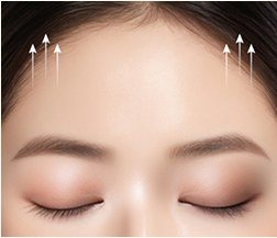 이마를 위로 당기는 리프팅 과정 일러스트