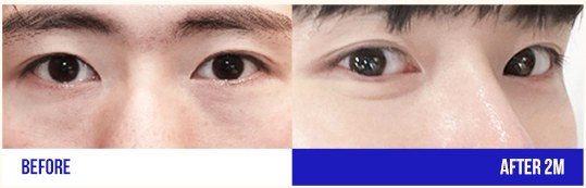 눈 성형 전후 사진 (남성, 2개월 경과)