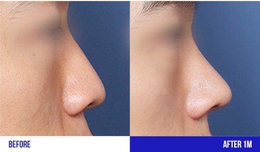 코 성형 측면 전후 비교 사진 (BEFORE / AFTER 1M)