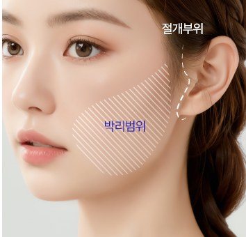 두피·이주라인 절개 및 박리 범위 표시 일러스트