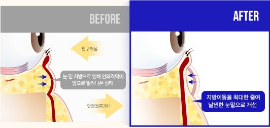 눈 밑 지방 및 안와격막 재배치 전후 비교 일러스트