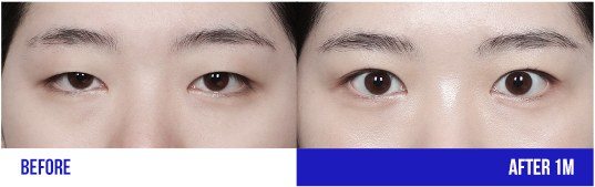 눈 성형 전후 비교 사진