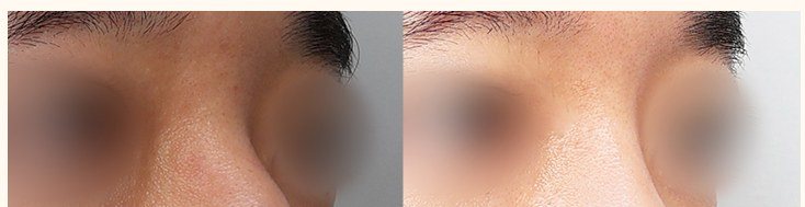 코 성형 전후 사진 (부분 잘림)
