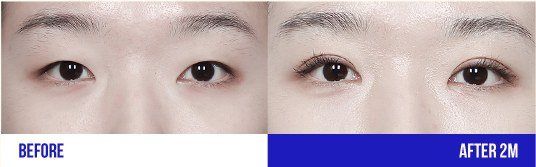 눈 성형 전후 비교 사진 (BEFORE / AFTER 2M)