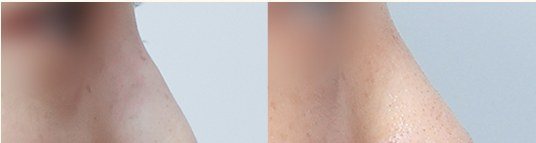 낮은코성형 전후 비교 사진