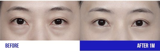 눈 성형 전후 비교 사진