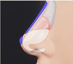 보형물 삽입 일러스트