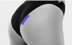자가진피 채취 부위가 표시된 둔부 흑백 사진
